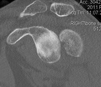 Posterior Shoulder Dislocation Sagittal CT